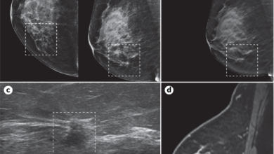 Breast Cancer Insights, Challenges, and Advances